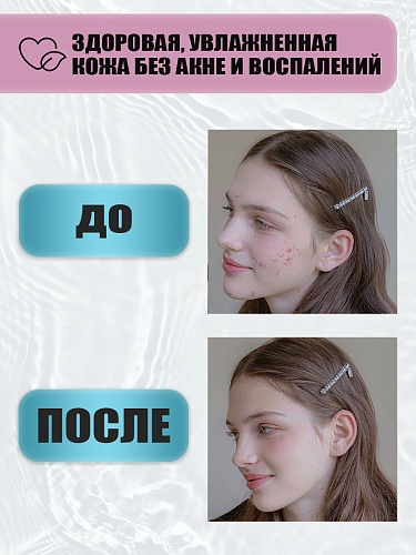 Крем-гель для лица от прыщей STOP ACNE, 50 мл Крем-гель для лица от прыщей STOP ACNE, 50 мл